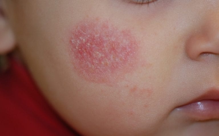 La Dermatite Seborroica Che Cos E Come Curarla